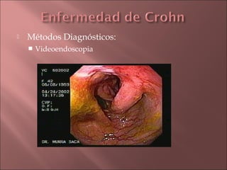    Métodos Diagnósticos:
       Videoendoscopia
 