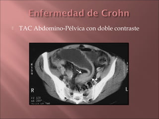    TAC Abdomino-Pélvica con doble contraste
 