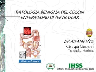 PATOLOGIA BENIGNA DEL COLON
ENFERMEDAD DIVERTICULAR

DR.MEMBREŇO
Cirugía General
Tegucigalpa, Honduras

 