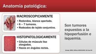 Anatomía patológica:
MACROSCOPICAMENTE
•Redondos, blanco aperlado.
•6 – 7 tumores.
•Rodeados de tejido conjuntivo.
HISTOPATOLOGICAMENTE
•Células de músculo liso
alargadas.
•Haces en ángulos rectos.
Son tumores
expuestos a la
hipoperfusión e
isquemia.
Schorge. (2009). Williams GINECOLOGÍA. Mc Graw Hill.
 