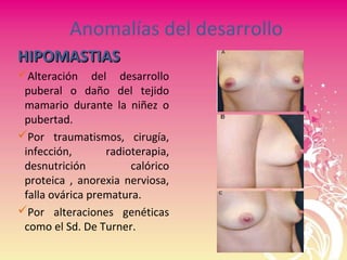 Anomalías del desarrollo
HIPOMASTIASHIPOMASTIAS
Alteración del desarrollo
puberal o daño del tejido
mamario durante la niñez o
pubertad.
Por traumatismos, cirugía,
infección, radioterapia,
desnutrición calórico
proteica , anorexia nerviosa,
falla ovárica prematura.
Por alteraciones genéticas
como el Sd. De Turner.
 