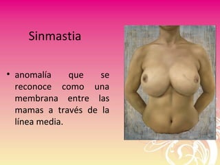 Sinmastia
• anomalía que se
reconoce como una
membrana entre las
mamas a través de la
línea media.
 