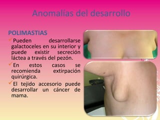 Anomalías del desarrollo
POLIMASTIAS
Pueden desarrollarse
galactoceles en su interior y
puede existir secreción
láctea a través del pezón.
En estos casos se
recomienda extirpación
quirúrgica.
El tejido accesorio puede
desarrollar un cáncer de
mama.
 