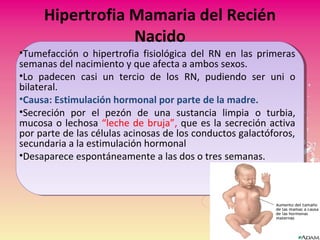 Hipertrofia Mamaria del Recién
Nacido
•Tumefacción o hipertrofia fisiológica del RN en las primeras
semanas del nacimiento y que afecta a ambos sexos.
•Lo padecen casi un tercio de los RN, pudiendo ser uni o
bilateral.
•Causa: Estimulación hormonal por parte de la madre.
•Secreción por el pezón de una sustancia limpia o turbia,
mucosa o lechosa “leche de bruja”, que es la secreción activa
por parte de las células acinosas de los conductos galactóforos,
secundaria a la estimulación hormonal
•Desaparece espontáneamente a las dos o tres semanas.
 