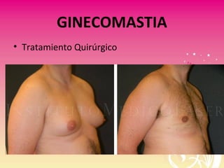 GINECOMASTIA
• Tratamiento Quirúrgico
 