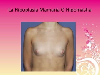 La Hipoplasia Mamaria O Hipomastia
 