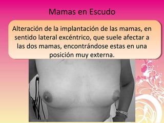 Mamas en Escudo
Alteración de la implantación de las mamas, en
sentido lateral excéntrico, que suele afectar a
las dos mamas, encontrándose estas en una
posición muy externa.
 