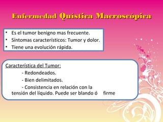 EnfermedadEnfermedad Quística MacroscópicaQuística Macroscópica
• Es el tumor benigno mas frecuente.
• Síntomas característicos: Tumor y dolor.
• Tiene una evolución rápida.
Característica del Tumor:
- Redondeados.
- Bien delimitados.
- Consistencia en relación con la
tensión del líquido. Puede ser blando ó firme
 