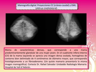 Mama de características densas, que corresponde a una mama
predominantemente glandular de una mujer joven. En el cuadrante infero-interno
(CII) de la mama izquierda se aprecia una imagen densa ovalada, homogénea de
contorno bien delimitado de 4 centímetros de diámetro mayor, que correspondía
histológicamente a un fibroadenoma. (Un quiste mamario presentaría la misma
imagen mamográfica). Cortesía Dr. Rafael Salvador Unidadde Radiología Mamaria.
Hospital de Vall d´Hebrón.
Mama de características densas, que corresponde a una mama
predominantemente glandular de una mujer joven. En el cuadrante infero-interno
(CII) de la mama izquierda se aprecia una imagen densa ovalada, homogénea de
contorno bien delimitado de 4 centímetros de diámetro mayor, que correspondía
histológicamente a un fibroadenoma. (Un quiste mamario presentaría la misma
imagen mamográfica). Cortesía Dr. Rafael Salvador Unidadde Radiología Mamaria.
Hospital de Vall d´Hebrón.
Mamografía digital. Proyecciones CC (cráneo-caudal) y OML
(oblicuo mediolateral).
Mamografía digital. Proyecciones CC (cráneo-caudal) y OML
(oblicuo mediolateral).
 