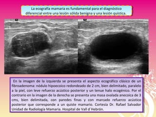 En la imagen de la izquierda se presenta el aspecto ecográfico clásico de un
fibroadenoma: nódulo hipoecoico redondeado de 2 cm, bien delimitado, paralelo
a la piel, con leve refuerzo acústico posterior y un tenue halo ecogénico. Por el
contrario en la imagen de la derecha se presenta una masa ovalada anecoica de 3
cms, bien delimitada, con paredes finas y con marcado refuerzo acústico
posterior que corresponde a un quiste mamario. Cortesía Dr. Rafael Salvador
Unidad de Radiología Mamaria. Hospital de Vall d´Hebrón.
En la imagen de la izquierda se presenta el aspecto ecográfico clásico de un
fibroadenoma: nódulo hipoecoico redondeado de 2 cm, bien delimitado, paralelo
a la piel, con leve refuerzo acústico posterior y un tenue halo ecogénico. Por el
contrario en la imagen de la derecha se presenta una masa ovalada anecoica de 3
cms, bien delimitada, con paredes finas y con marcado refuerzo acústico
posterior que corresponde a un quiste mamario. Cortesía Dr. Rafael Salvador
Unidad de Radiología Mamaria. Hospital de Vall d´Hebrón.
La ecografía mamaria es fundamental para el diagnóstico
diferencial entre una lesión sólida benigna y una lesión quística.
La ecografía mamaria es fundamental para el diagnóstico
diferencial entre una lesión sólida benigna y una lesión quística.
 