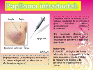 Se puede tomar una radiografía con medio
de contraste inyectado en el conducto
afectado (ductograma).
Se puede realizar un examen de las
células (citológico) de la secreción
para identificar células
potencialmente malignas
(cancerosas).
Es necesario efectuar una
biopsia de mama para hacer un
diagnóstico definitivo y descartar
un cáncer
Tratamiento
Extirpación quirúrgica (excisión)
del conducto comprometido y de la
masa de células, con la finalidad
de realizar una biopsia y de
descartar la presencia de un
cáncer.
 