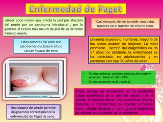 • Prurito, eritema, cambios erosivos del pezón y
secreción. Masa en 30 – 60%.
• Tx: mastectomía total o radical.
cáncer poco común que afecta la piel por afección
del pezón por un carcinoma intraductal , por lo
general, el círculo más oscuro de piel de su derredor
llamado areola.
cáncer poco común que afecta la piel por afección
del pezón por un carcinoma intraductal , por lo
general, el círculo más oscuro de piel de su derredor
llamado areola.
Casi siempre, tienen también uno o dos
tumores en el interior del mismo seno.
Casi siempre, tienen también uno o dos
tumores en el interior del mismo seno.
Estas células se encuentran en la epidermis
(capa superficial) de la piel del pezón y de la
areola. A menudo tienen una apariencia grande,
redonda, al microscopio; se pueden encontrar
como células aisladas o como grupos pequeños
de células en el interior de la epidermis.
Una biopsia del pezón permite
diagnosticar correctamente la
enfermedad de Paget de seno.
Una biopsia del pezón permite
diagnosticar correctamente la
enfermedad de Paget de seno.
Estos tumores del seno son
carcinomas ductales in situ o
cáncer invasor de seno
Estos tumores del seno son
carcinomas ductales in situ o
cáncer invasor de seno
presenta mujeres o hombres, mayoría de
los casos ocurren en mujeres. La edad
promedio , tiempo del diagnóstico es de
57 años; no obstante, la enfermedad se
ha detectado en adolescentes y en
personas con casi 90 años de edad .
 