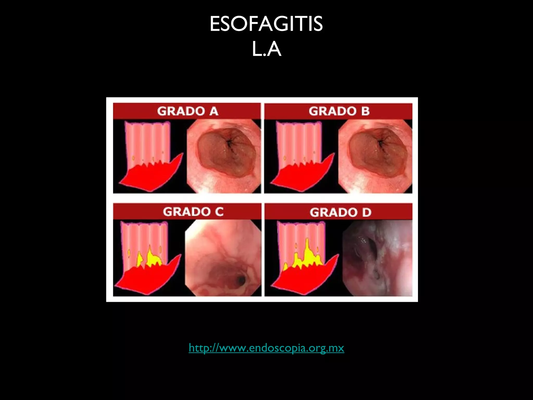 Patologia benigna esofago 2 | PPT
