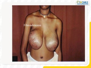 Fibroadenoma 