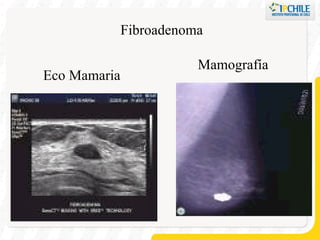 Eco Mamaria Mamografía Fibroadenoma 