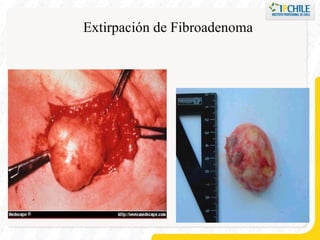 Extirpación de Fibroadenoma 