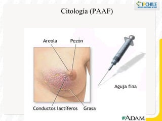 Citología (PAAF) 
