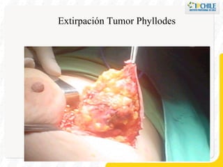 Extirpación Tumor Phyllodes 