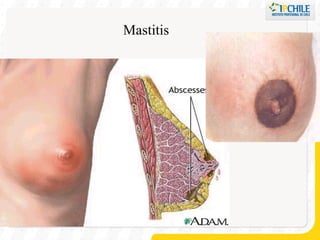 Mastitis 