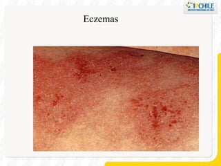 Eczemas 