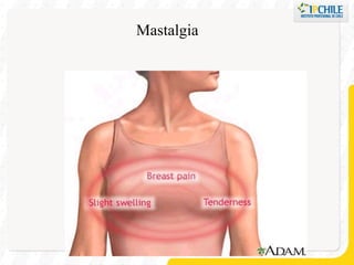 Mastalgia 