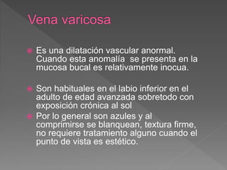 Es una dilatación vascular anormal.
Cuando esta anomalía se presenta en la
mucosa bucal es relativamente inocua.
 Son habituales en el labio inferior en el
adulto de edad avanzada sobretodo con
exposición crónica al sol
 Por lo general son azules y al
comprimirse se blanquean, textura firme,
no requiere tratamiento alguno cuando el
punto de vista es estético.
 