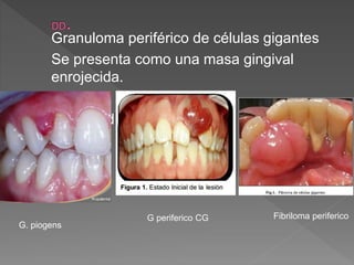 Granuloma periférico de células gigantes
Se presenta como una masa gingival
enrojecida.
Fibriloma Periferico
Tonalidad mucho mas clara
G periferico CG
G. piogens
Fibriloma periferico
 