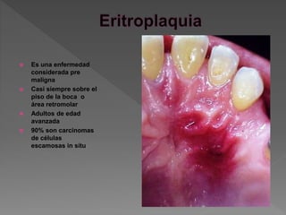  Es una enfermedad
considerada pre
maligna
 Casi siempre sobre el
piso de la boca o
área retromolar
 Adultos de edad
avanzada
 90% son carcinomas
de células
escamosas in situ
 