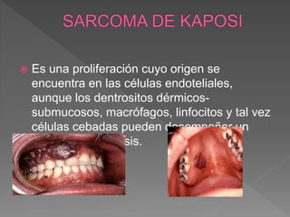  Es una proliferación cuyo origen se
encuentra en las células endoteliales,
aunque los dentrositos dérmicos-
submucosos, macrófagos, linfocitos y tal vez
células cebadas pueden desempeñar un
papel en su génesis.
 
