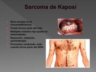  Raro excepto en la
inmunodeficiencia
 Puede formar parte del sida
 Múltiples nódulos rojo azules en
extremidades
 Resección, radiación,
quimioterapia
 Pronostico moderado, malo
cuando forma parte del SIDA
 