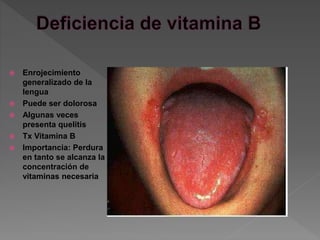  Enrojecimiento
generalizado de la
lengua
 Puede ser dolorosa
 Algunas veces
presenta quelitis
 Tx Vitamina B
 Importancia: Perdura
en tanto se alcanza la
concentración de
vitaminas necesaria
 