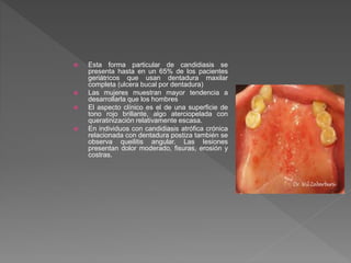  Esta forma particular de candidiasis se
presenta hasta en un 65% de los pacientes
geriátricos que usan dentadura maxilar
completa (ulcera bucal por dentadura)
 Las mujeres muestran mayor tendencia a
desarrollarla que los hombres
 El aspecto clínico es el de una superficie de
tono rojo brillante, algo aterciopelada con
queratinización relativamente escasa.
 En individuos con candidiasis atrófica crónica
relacionada con dentadura postiza también se
observa queilitis angular. Las lesiones
presentan dolor moderado, fisuras, erosión y
costras.
 