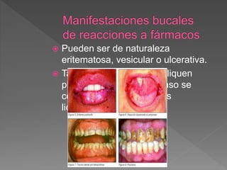  Pueden ser de naturaleza
eritematosa, vesicular o ulcerativa.
 También pueden simular liquen
plano erosivo, en cuyo caso se
conocen como reacciones
liquenoides a fármacos
 