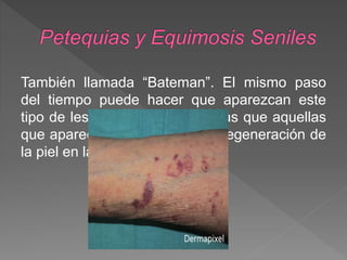 También llamada “Bateman”. El mismo paso
del tiempo puede hacer que aparezcan este
tipo de lesiones, que no son más que aquellas
que aparecen por una natural degeneración de
la piel en las personas mayores.
 