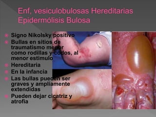  Signo Nikolsky positivo
 Bullas en sitios de
traumatismo menor
como rodillas y codos, al
menor estimulo
 Hereditaria
 En la infancia
 Las bullas pueden ser
graves y ampliamente
extendidas
 Pueden dejar cicatriz y
atrofia
 