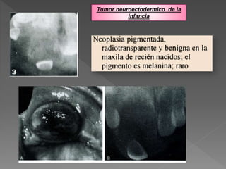 Tumor neuroectodermico de la
infancia
 