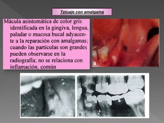 Tatuaje con amalgama
 