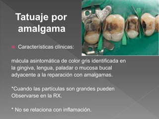  Características clínicas:
mácula asintomática de color gris identificada en
la gingiva, lengua, paladar o mucosa bucal
adyacente a la reparación con amalgamas.
*Cuando las partículas son grandes pueden
Observarse en la RX.
* No se relaciona con inflamación.
Tatuaje por
amalgama
 