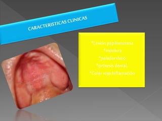 *Lesión papilomatosa
*indolora
*paladar duro
*prótesis dental.
*Color rojo Inflamación
 