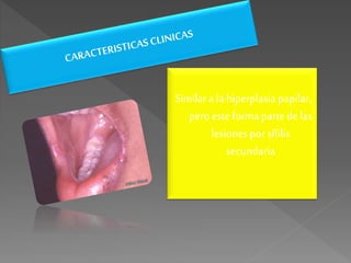 Similar a lahiperplasiapapilar,
peroesteformaparte delas
lesionespor sífilis
secundaria
 
