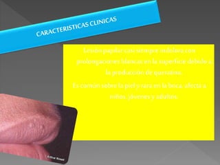 Lesiónpapilarcasi siempreindolora con
prolongaciones blancas en la superficiedebidoa
la producción de queratina.
Es común sobre la piely rara en laboca, afectaa
niños, jóvenes y adultos.
 
