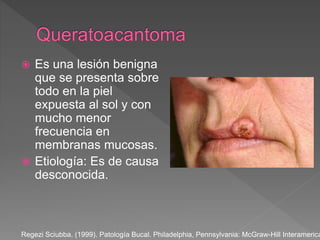  Es una lesión benigna
que se presenta sobre
todo en la piel
expuesta al sol y con
mucho menor
frecuencia en
membranas mucosas.
 Etiología: Es de causa
desconocida.
Regezi Sciubba. (1999). Patología Bucal. Philadelphia, Pennsylvania: McGraw-Hill Interamerica
 