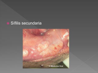  Sífilis secundaria
 