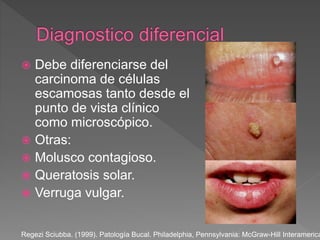  Debe diferenciarse del
carcinoma de células
escamosas tanto desde el
punto de vista clínico
como microscópico.
 Otras:
 Molusco contagioso.
 Queratosis solar.
 Verruga vulgar.
Regezi Sciubba. (1999). Patología Bucal. Philadelphia, Pennsylvania: McGraw-Hill Interamerica
 