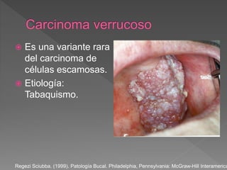  Es una variante rara
del carcinoma de
células escamosas.
 Etiología:
Tabaquismo.
Regezi Sciubba. (1999). Patología Bucal. Philadelphia, Pennsylvania: McGraw-Hill Interamerica
 