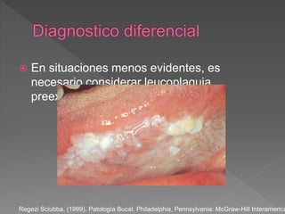 En situaciones menos evidentes, es
necesario considerar leucoplaquia
preexistente.
Regezi Sciubba. (1999). Patología Bucal. Philadelphia, Pennsylvania: McGraw-Hill Interamerica
 