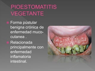  Forma pústular
benigna crónica de
enfermedad muco-
cutanea .
 Relacionada
principalmente con
enfermedad
inflamatoria
intestinal.
 