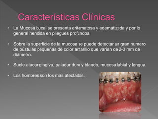 • La Mucosa bucal se presenta eritematosa y edematizada y por lo
general hendida en pliegues profundos.
• Sobre la superficie de la mucosa se puede detectar un gran numero
de pústulas pequeñas de color amarillo que varían de 2-3 mm de
diámetro.
• Suele atacar gingiva, paladar duro y blando, mucosa labial y lengua.
• Los hombres son los mas afectados.
 