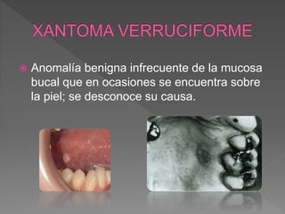  Anomalía benigna infrecuente de la mucosa
bucal que en ocasiones se encuentra sobre
la piel; se desconoce su causa.
 