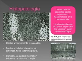 Se encuentran
diferentes células
espumosas o
Xantomatosas en la
lamina propia.
La ultraestructura de
las células espumosas
los clasifican mejor
como macrófagos.
• Criptas uniformemente invaginadas.
• Bordes epiteliales alargados se
extienden hacia la lamina propia.
• Componente epitelial normal sin
evidencia de displasia o atipia.
 